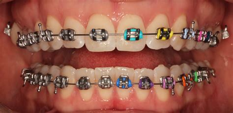 stainless steel orthodontic braces